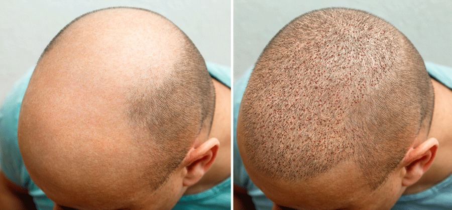 Beach After Hair Transplant